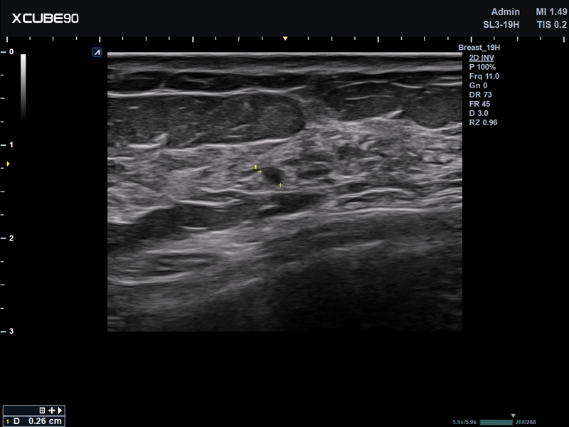 Breast cyst