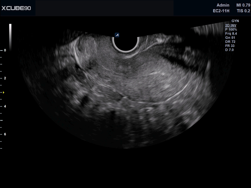 Uterus in 2D mode