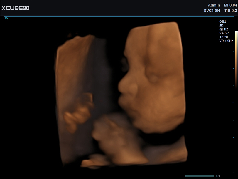 Fetus face with Depth view