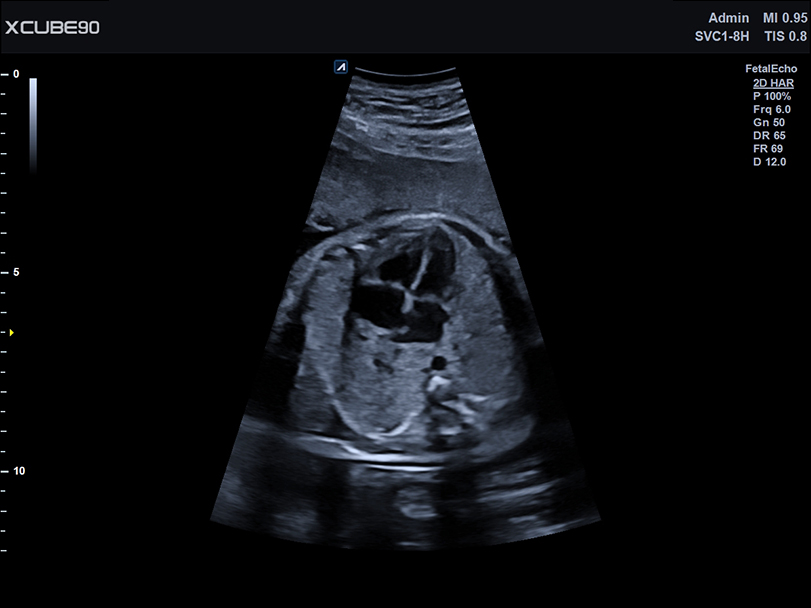 Fetal echo