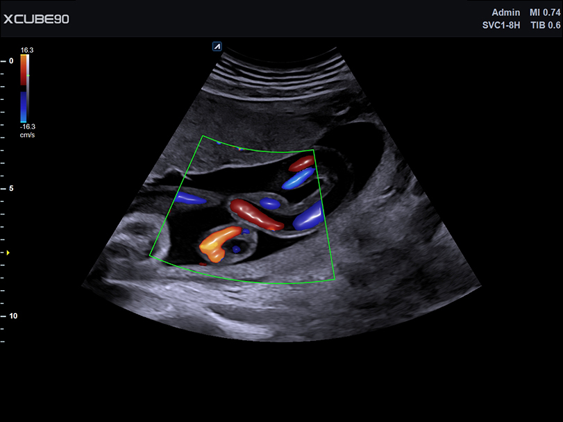 Fetal cord brilliant flow