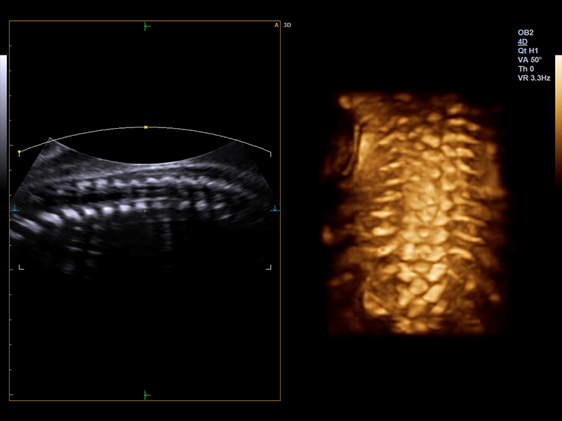 Surface fetal spine