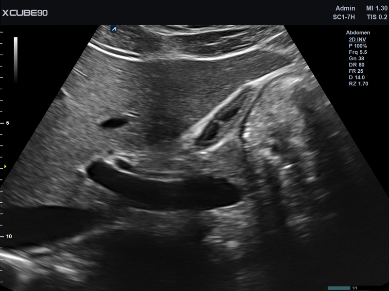 Gallbladder in 2D mode