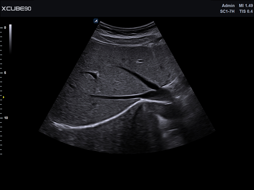 Hepatic Vein