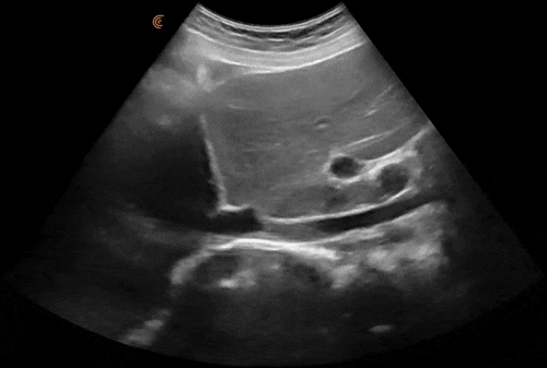 Abdominal-Liver-IVC-GIF-1